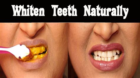 Magic natuarl teeth whitening
